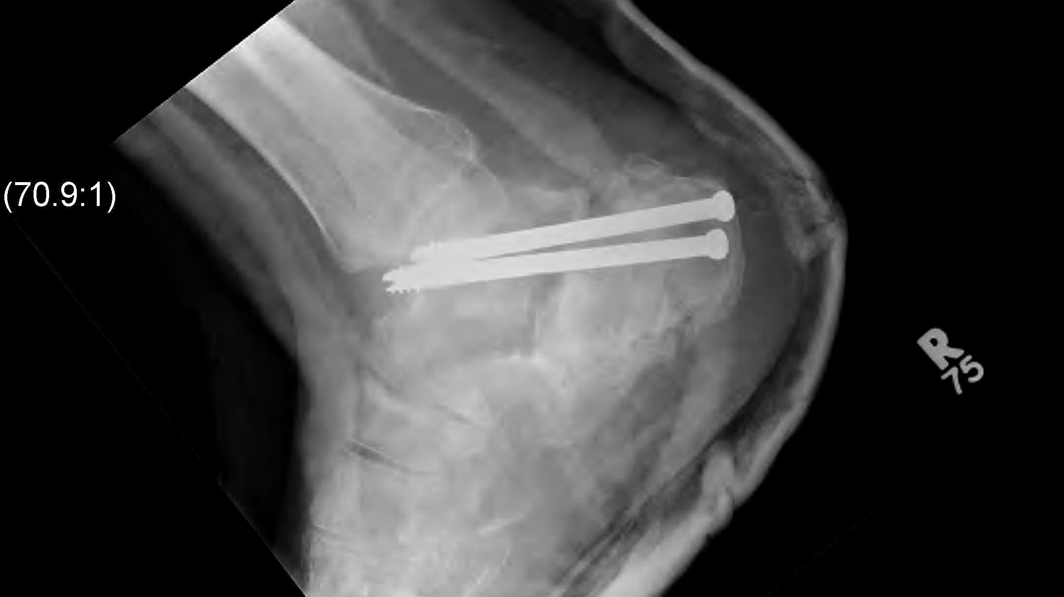 Calcaneal Fracture OA Post Fusion